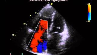 15 Severity of tricuspid regurgitation [upl. by Joaquin]