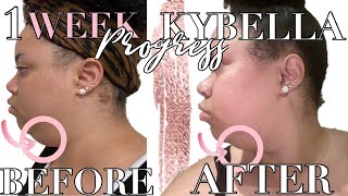 1 Week PostInjection Update  Kybella Vlog Part 2 [upl. by Nnilsia]