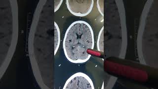 INTRACRANIAL CALCIFICATION doctor hospital  shorts video [upl. by Ahsain]