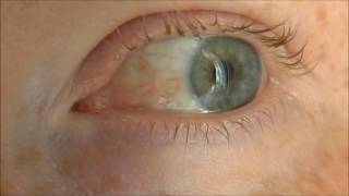 Episcleritis a benign inflammatory eye condition before and after treatment [upl. by Cain164]