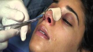 The Kotler Nasal Airway  Removal of the Airway [upl. by Vedetta820]