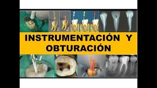 quotINSTRUMENTACION Y OBTURACIÓNquot por el Dr Nestor Jaime [upl. by Nelson]