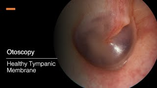 Tympanic Membrane Otosopy [upl. by Nyleda]