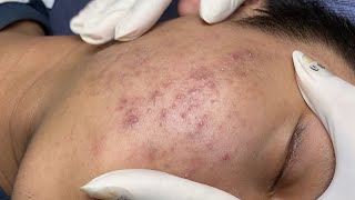 ACNE TREATMENT VU QUYNH MI Acne On Teens Chin 2024 [upl. by Enyaj]