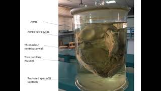 Myocardial infarction Pathology Lab [upl. by Seda350]