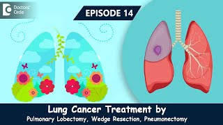 Role of Pulmonary Lobectomy Wedge Resection amp Pneumonectomy in Lung Cancer  DrSandeep Nayak [upl. by Airamahs550]