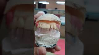 Cast partial denture tooth setup dentisry dentist dentalprosthesis dentition partialdenture [upl. by Votaw]