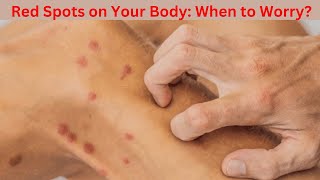 RevealedRed Spots on Your Body When to Worry [upl. by Mcconaghy]