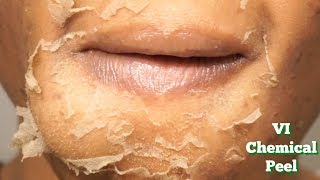 CHEMICAL PEEL Full Process  Procedure  Peeling  Before amp After [upl. by Kennett613]