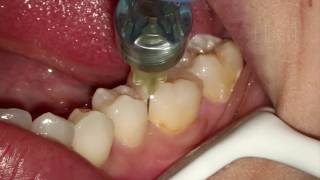 Endodontia de Molar Inferior [upl. by Tani]