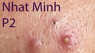 Acne Treatment Huong Da Nang 029  Treatment for Nhat Minh Part 2 [upl. by Lindgren888]