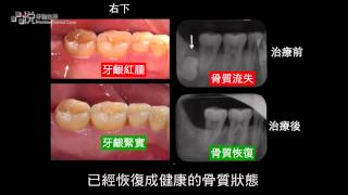 品悅牙醫診所牙周病治療 植牙牙周專科張志嘉醫師 [upl. by Atiraj]