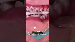 What is Phase 1 in orthodontic treatment  Tooth Time Family Dentistry New Braunfels [upl. by Treve960]