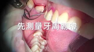 顯微牙周病牙齒搖治療，牙齦下牙結石刮除治療牙齦流血gum treatment 顯微微創治療新趨勢 [upl. by Panthea]