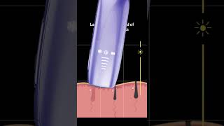 Why Choose IPL Hair Removal The Benefits of LightBased Technology Rxmoore IPL hair removal [upl. by Hessney]