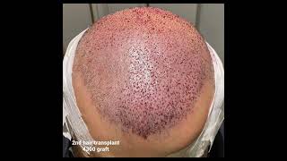 10 days look after Hair transplant 4300 graft [upl. by Macmahon]