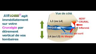 Vous souffrez de cruralgie  visualisez le soulagement quAIRLOMB vous apporterait sur vos lombaires [upl. by Naghem]