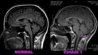 Chiari Malformation Type 1 Surgery  My Recovery loud noises [upl. by Resee910]