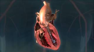 Impella® Heart Pump Animation For Patients [upl. by Filberte934]