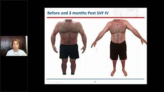 Intravenous implantation of stromal vascular fraction in psoriasis  Video abstract ID 163612 [upl. by Ibba]