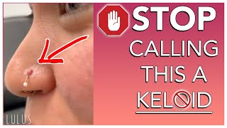 STOP CALLING BUMPS ON YOUR PIERCING KELOIDS [upl. by Finley]