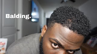 So Im Balding In My 20s [upl. by Eillil]