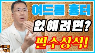 여드름 흉터❗없애려면❓필수상식❗ 여드름흉터 여드름흉터없애는방법 여드름흉터없애는법 여드름자국 [upl. by Farron]