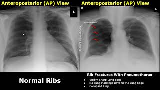 Chest XRay Ribs Normal Vs Abnormal Image Appearances  Fractures Pneumothorax Flail Chest CXR [upl. by Ardussi]