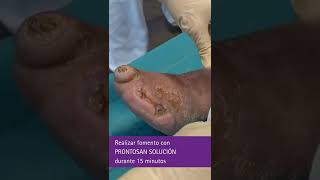 Prontosan® Solución y Askina® Calgitrol® Paste garantizan el tratamiento de heridas infectadas [upl. by Aysa]