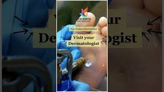 Worried about wart  Cutis Hospital Bangalore  Wart Treatment Skin Care Electrosurgery for warts [upl. by Assilat224]