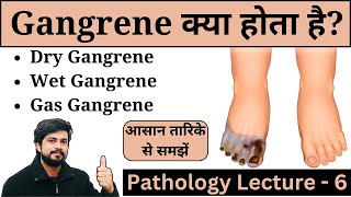 Gangrene  Types of Gangrene  Gas Dry amp Wet  Treatment  Pathology Lecture in Hindi [upl. by Hallvard986]