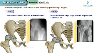 Dislocation Of Hip Orthopedics Lecture [upl. by Isabelle623]