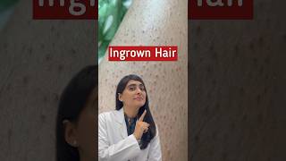 Ingrown Hair Removal  Ingrown Hair  Strawberry Legs shorts [upl. by Letitia691]