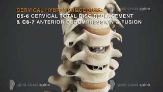 Cervical Hybrid – Cervical Spine Surgery [upl. by Tennek690]