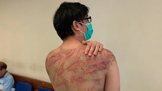 Hong Kong triad attack victim recounts ordeal [upl. by Tabber]