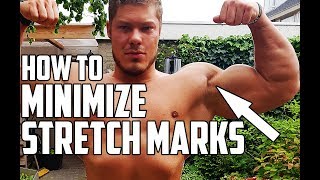 Stretch Marks Why you get them amp How to minimize them [upl. by Nosnev]