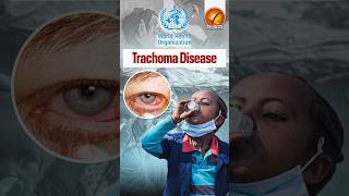 Trachoma Disease shorts [upl. by Lorinda246]