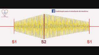 Soplo de la persistencia del conducto arterioso [upl. by Anoynek]