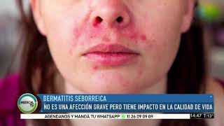 MEDICAL TV Dermatitis Seborreica [upl. by Adnahcir]