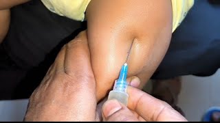 Arms injection video Intramuscular Ceftriaxone 500mg Exephin injection push24 P28 by cannula 69 [upl. by Garland921]