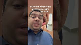 Qual antihipertensivo causa hiperplasia gengival cardiologia shorts [upl. by Laurens]