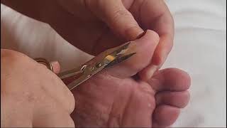 Subscribe for more videos Callus Cutting Saga callus cutting toe callo occhio di pernice [upl. by Anikehs]