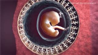 Animated Portrayal of Placenta Accreta Spectrum [upl. by Tim861]