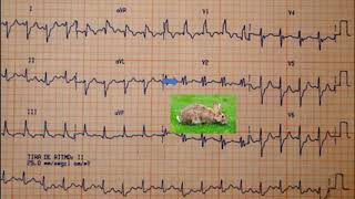 BLOQUEO DE RAMA DERECHA  INTERPRETACIÓN EN EL ELECTROCARDIOGRAMA [upl. by Oihsoy216]