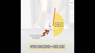 Over pronation rolling in to far can aggrivate your foot pain [upl. by Arahc]