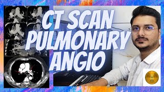 CT SCAN  Pulmonary angio filming process angiography pulmonary radiologytechnologist [upl. by Massarelli594]