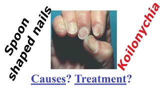 Spoon shaped nails koilonychia causes treatment [upl. by Nikoletta]