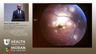 Uveitis Presentations [upl. by Onaireves]