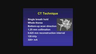 Pre Ablation Cardiac CT [upl. by Essilem175]