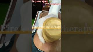 Fire cupping therapy 👨‍⚕️drsatishkumar health cuppingcupping therapy [upl. by Henryetta455]